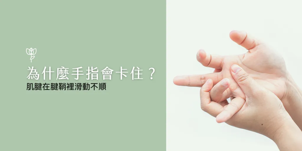 Illustration of what causes trigger finger - the tendon does not glide smoothly through its sheath