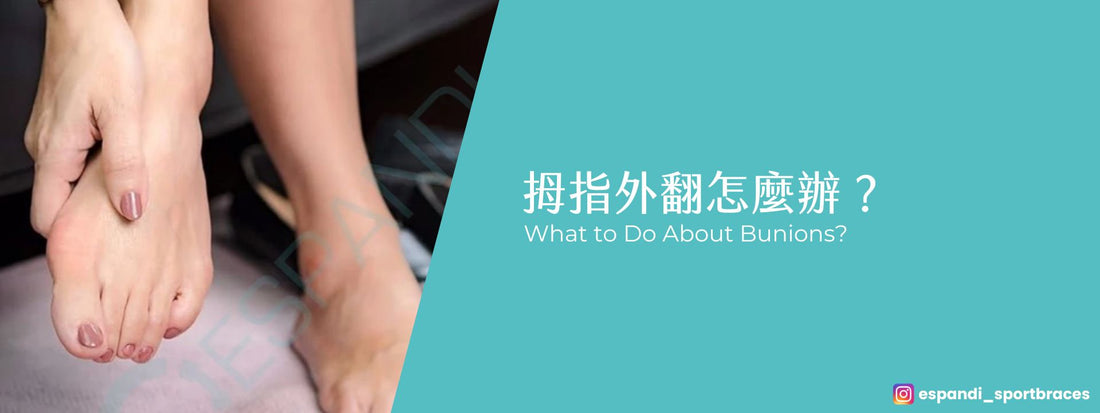 拇指外翻怎麼辦？從原因到改善的完整指南｜專業解析矯正方法與矯正器推薦