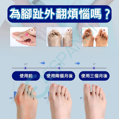 【美國™】拇指外翻帶(一雙) Bunion Corrector (pair)