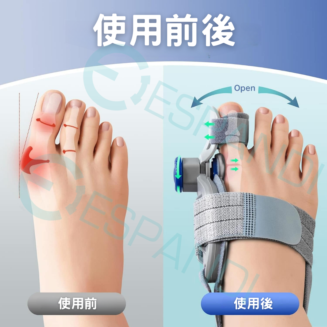 旋鈕式姆趾矯正器｜精準調整，貼合不同腳型 Dial-Adjustable Bunion Corrector